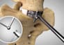 create 3d orthopedic surgery animation, knee replacement medical explainer video